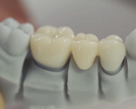 Closeup of tooth-coloured tooth bridge on dental model.