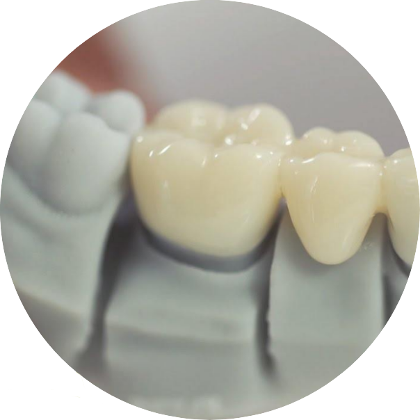 Closeup of tooth-coloured tooth bridge on dental model used for crowns & bridges.